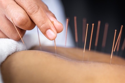 Up to 50% Off on Acupuncture at Pharmedico Pharmacy