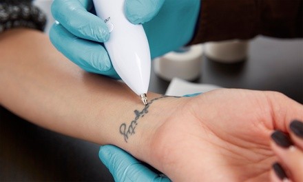 Up to 73% Off on Tattoo Removal at Accentuated Beauty