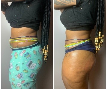 Up to 42% Off on Gluteoplasty / Butt Lift - Non-Surgical at Sol Transformations