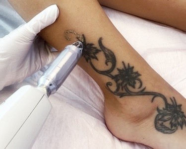 Up to 83% Off on Tattoo Removal at Dermaclinic New York