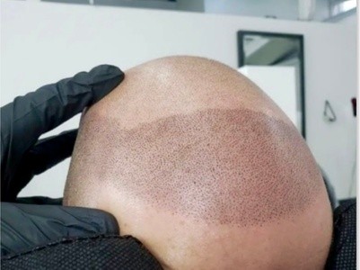 Up to 55% Off on Hair Restoration - Non-Surgical at Skalp ink micropigmentation