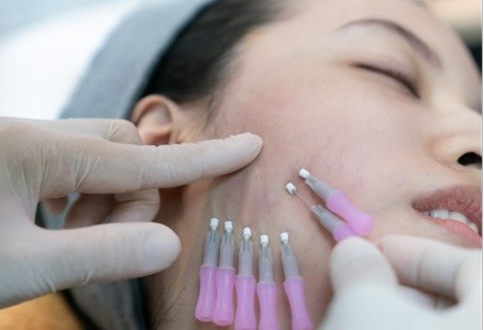 Up to 56% Off on Facelift - Thread Lift at Vitality Medspa