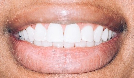 Up to 50% Off on Teeth Whitening at The Supreme Smile