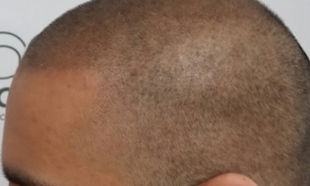 Up to 14% Off on Hair Restoration - Non-Surgical at TRUE LINE SMP