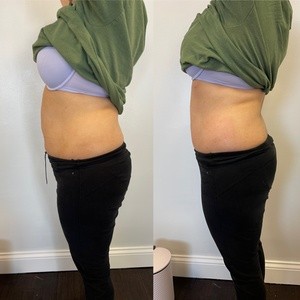 Up to 54% Off on Cavitation at Parlor Body Sculpture