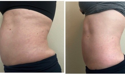 Up to 50% Off on Cavitation at Silhouette Sculpting
