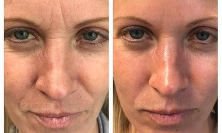 Up to 58% Off on Chemical Peel at Spa One Little Rock