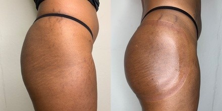 Up to 42% Off on Cupping at Bodysavy