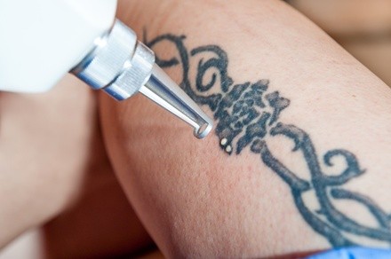 Up to 80% Off on Tattoo Removal at Tempe Laser Center