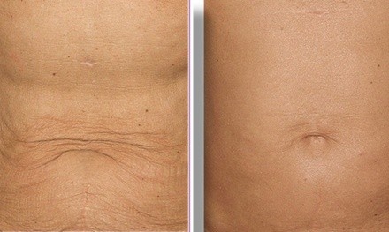 Up to 60% Off on Thermolifting at Shape Of You