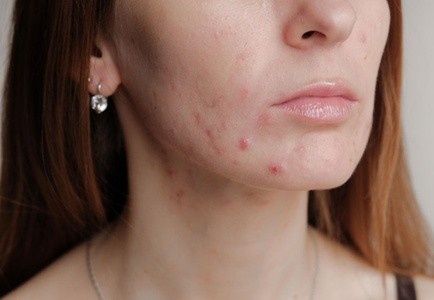 Up to 72% Off on Acne Treatment (Service) at Mod Facial Bar