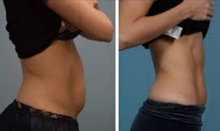 Up to 72% Off on EMsculpt with the option of 1 Cryo Liposculpt session at MOI-MODERN OUTPATIENT IMAGE