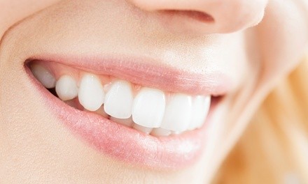 Two, Four, Six, or Eight Veneers at Elite Smiles (Up to 58% Off)