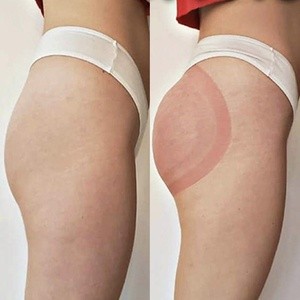 Up to 45% Off on Gluteoplasty / Butt Lift at Klassy Curves By K