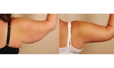 Up to 10% Off on Radio Frequency Skin Tightening at Enhanc’d By Ashley Starr