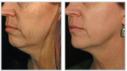 Up to 43% Off on Cavitation at Your sculpture