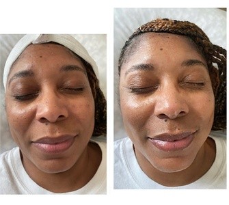 Up to 54% Off on Back Facial at SnatchBae Esthetics
