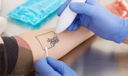 Three Tattoo-Removal Sessions at Seamless Aesthetics (Up to 67% Off). Four Options Available.