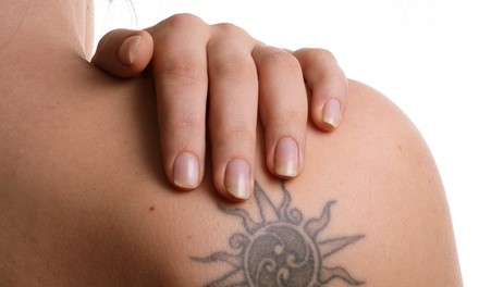 Up to 68% Off on Tattoo Removal at Red Diamond Laser Tattoo Removal