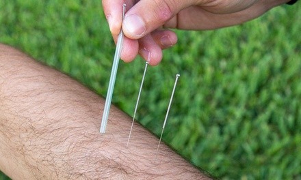 Up to 40% Off on Acupuncture at Lucky Cat Acupuncture