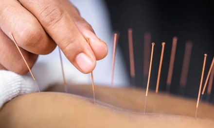 One, Two, or Three 60-Minute Acupuncture Treatments with Cupping Therapy at Holistic Elite (Up to 30% Off)