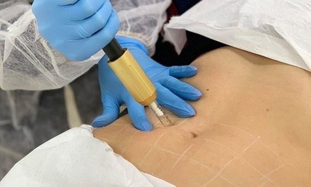 Up to 70% Off on Mesotherapy - Needleless at Excel Body Sculpting Shop