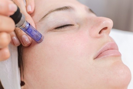 Up to 33% Off on Micro-Needling at The Unlimited Clinic