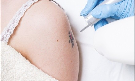 Up to 70% Off on Tattoo Removal at Beverly Hills Cosmetic Services Rancho Cucamonga