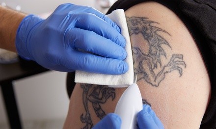 Three Tattoo-Removal Sessions at Forever MedSpa & Wellness Center (Up to 40% Off). Three Options Available.