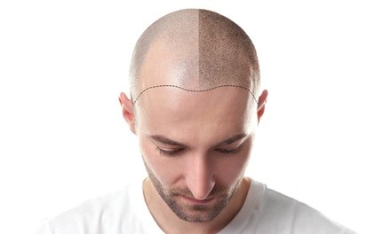 Scalp Micropigmentation at Valen Victoria (Up to 67% Off). Two Options Available.