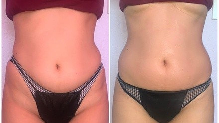 Up to 48% Off on Ultrasonic Fat Reduction at Bella 'Nai