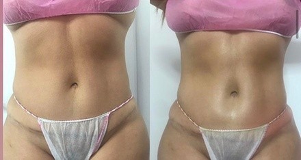 Up to 50% Off on Ultrasonic Fat Reduction at CAMP DollHouse Aesthetics