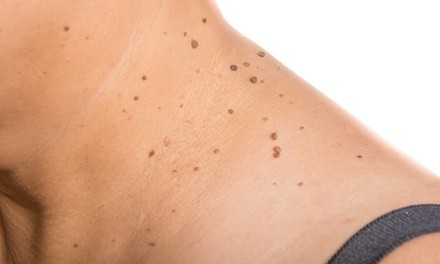 Up to 35% Off on Skin Tag Removal at Chanton In Beauty