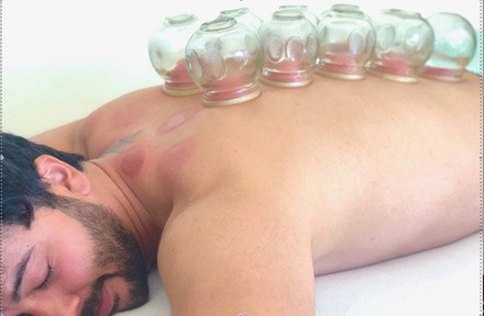 Up to 50% Off on Cupping at Acupuncture By The Sea, Melissa Kallsen, LAc