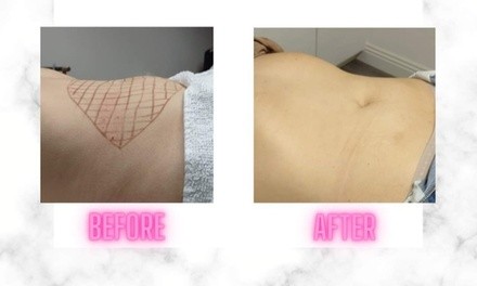 Up to 60% Off on Fat Reduction - Non-Branded at Lovely You Esthetics Beauty Academy & Spa