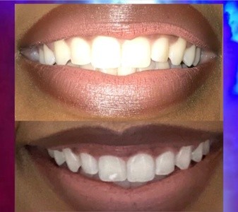 Up to 50% Off on Teeth Whitening - In-Office - Non-Branded at CAMP DollHouse Aesthetics