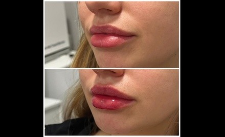 Up to 44% Off on Lip Enhancement at Ethereal Esthetics