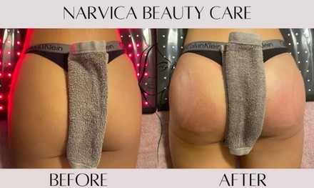 Up to 30% Off on Gluteoplasty / Butt Lift at Narvica