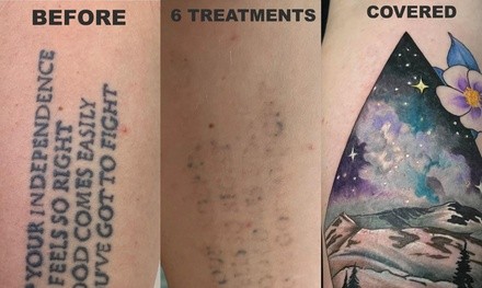 One, Three, or Six Laser Tattoo-Removal Sessions at Wise Choice Tattoo Removal (Up to 79% Off)